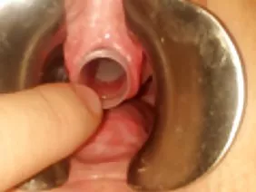 Puffy hole